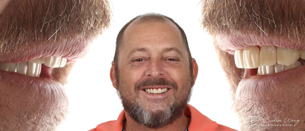 Smile after custom implant rehabilitation