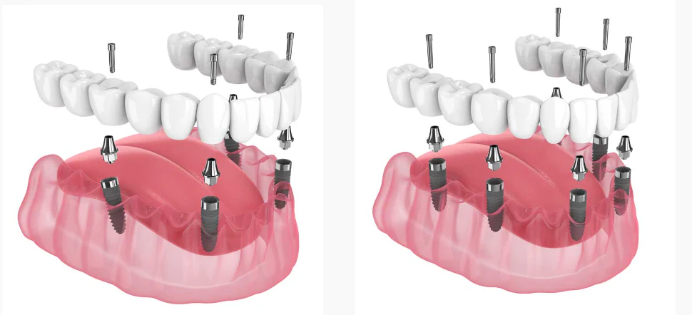 Puente fijo de arco completo All-on-4 soportado por cuatro implantes dentales